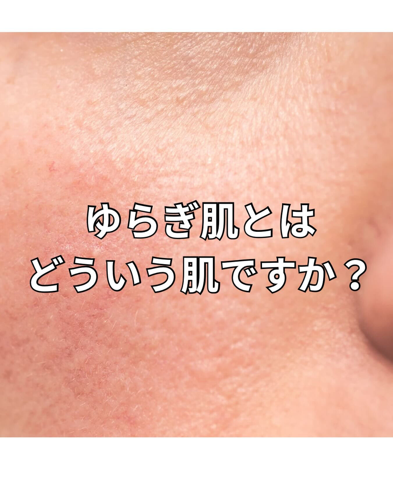 ゆらぎ肌とはどういう肌ですか？