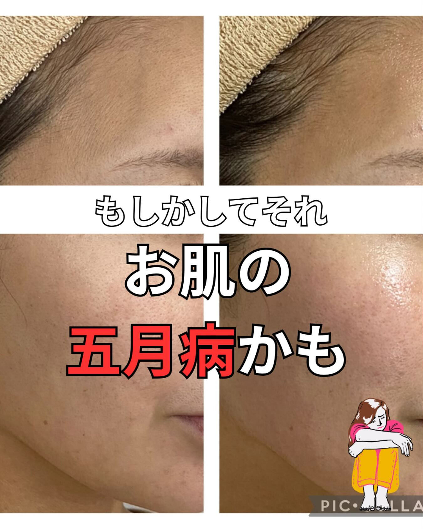 お肌の五月病とはなんですか？