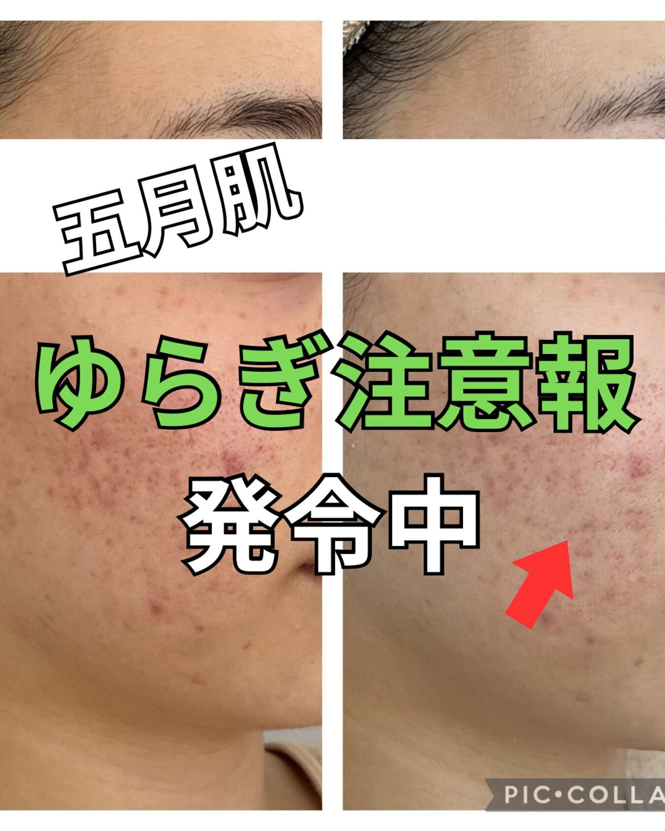 5月にニキビが増えるのはなぜ？