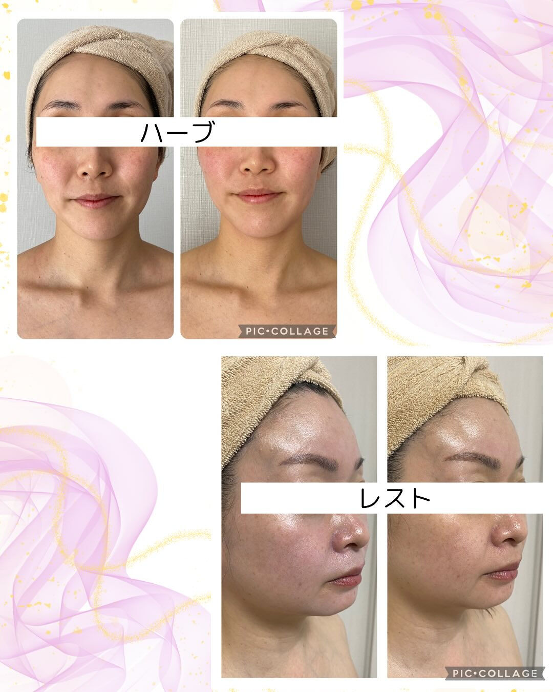 6月に肌荒れするのはなぜ？